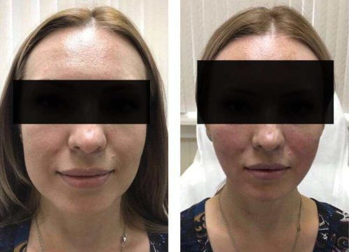 Kabelline photo review