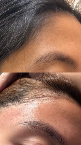 Rejuran S photo review