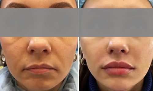 Neuramis Volume Lidocaine photo review