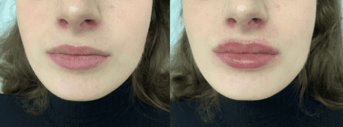 Chaeum Premium 3 photo review