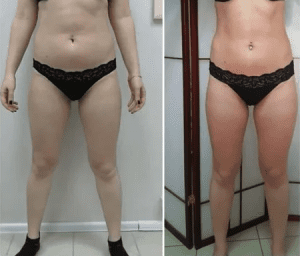 Lipo Lab PPC photo review