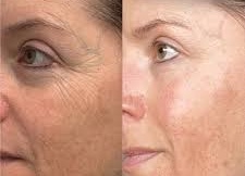 Exoxe face photo review