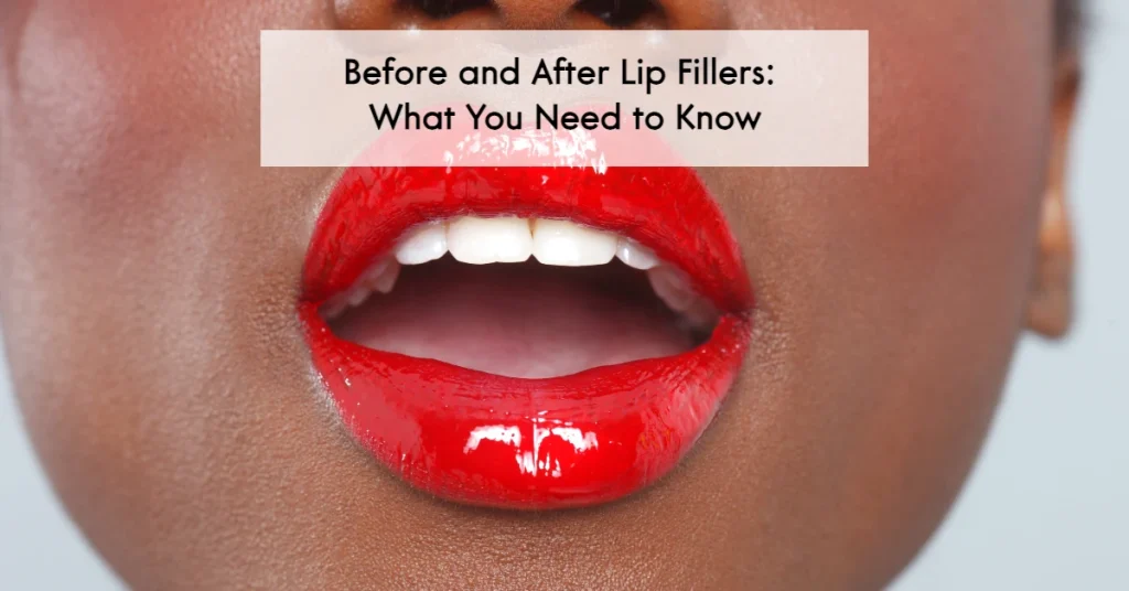 Before and After Lip Fillers: What You Need to Know